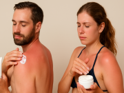 Crema per scottature solari